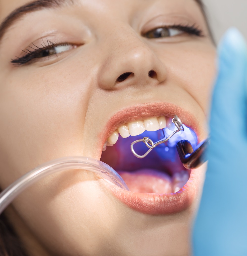Teeth Bonding