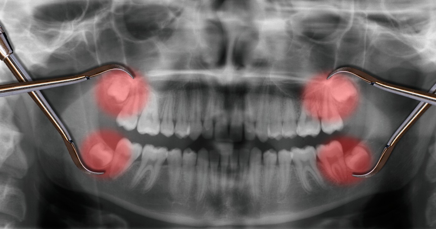 wisdom teeth over x-ray